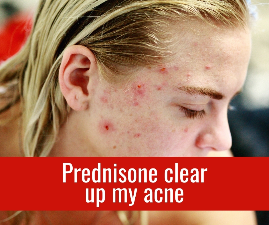 prednisone clear up my acne