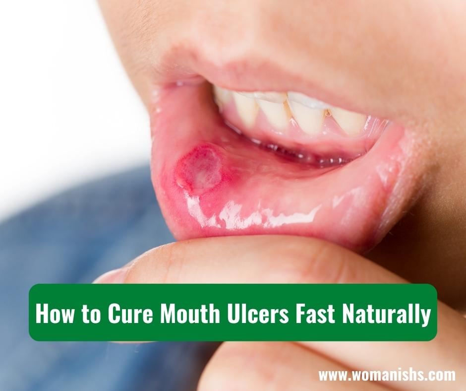 How to Cure Mouth Ulcers Fast Naturally