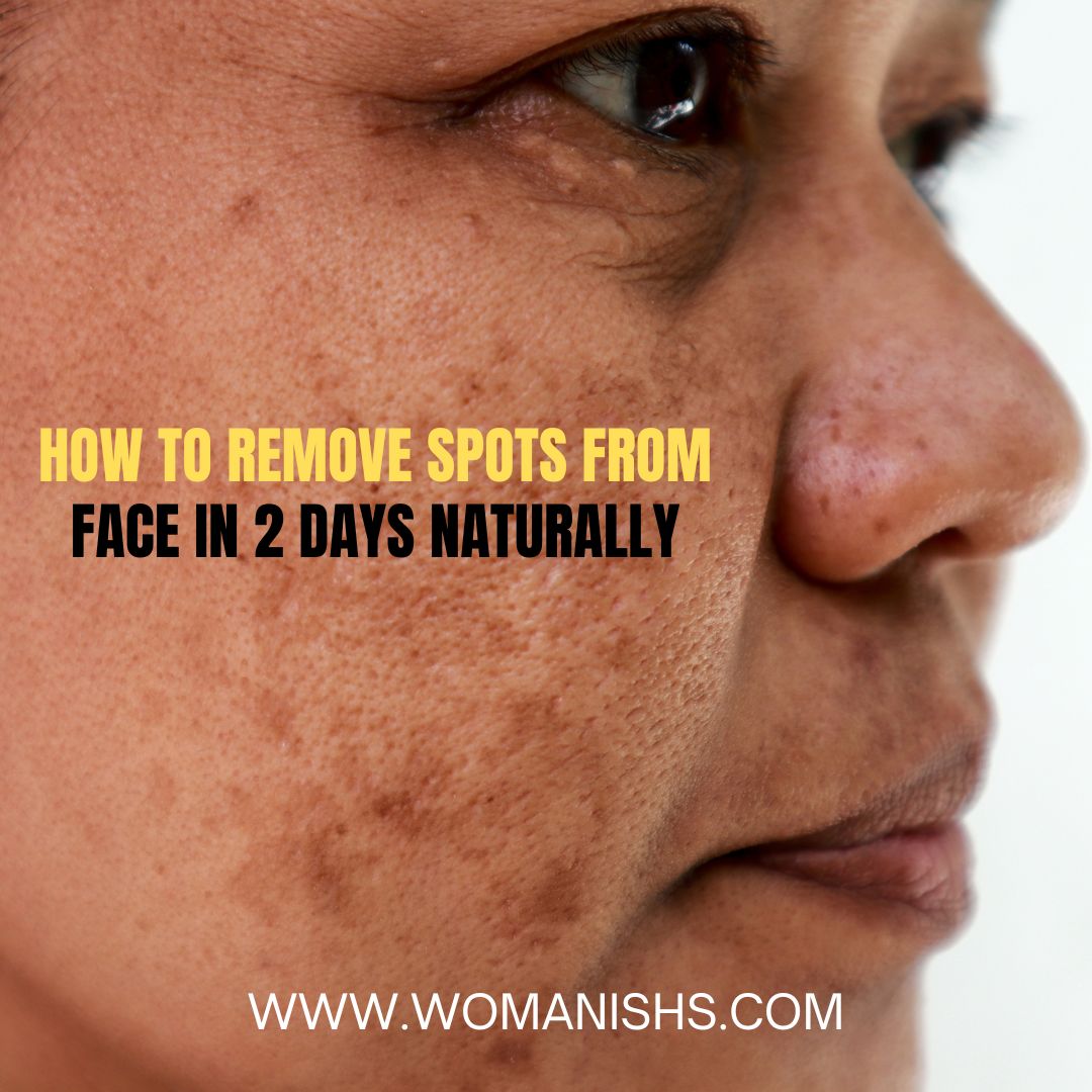 How To Remove Spots From Face In 2 Days Naturally