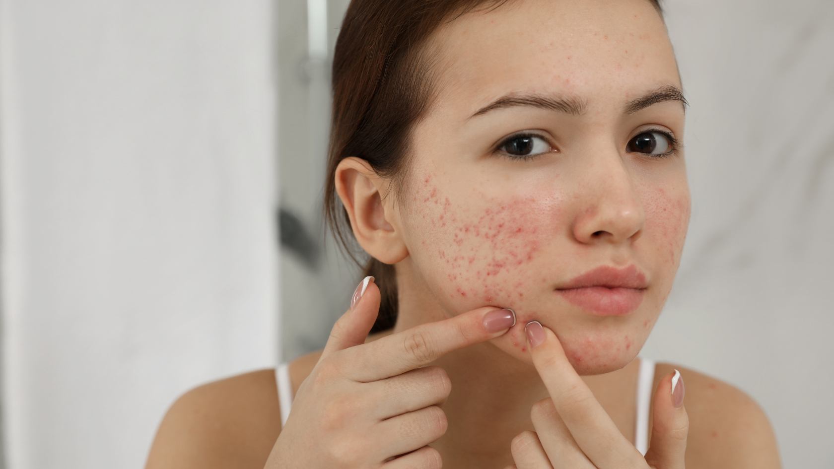 Natural considerations for treating pimples and acne