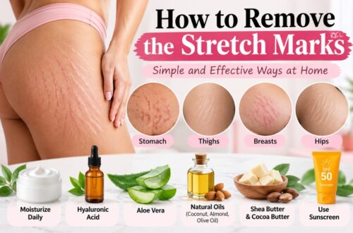 how to remove the stretch marks