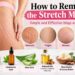 how to remove the stretch marks